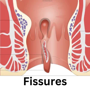 Anal Fissure