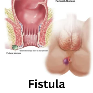 Peri Anal Fistula