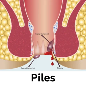 Piles (Hemorrhoids)